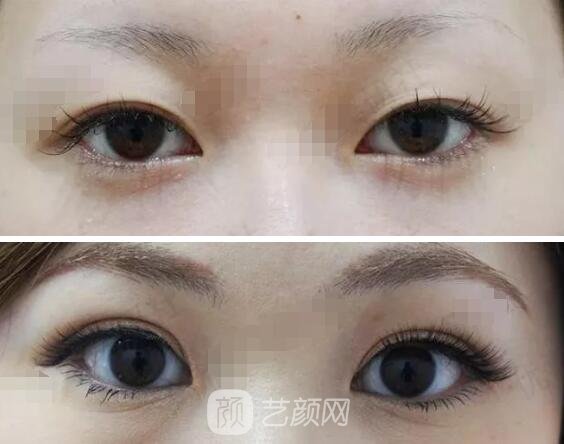埋線雙眼皮案例圖