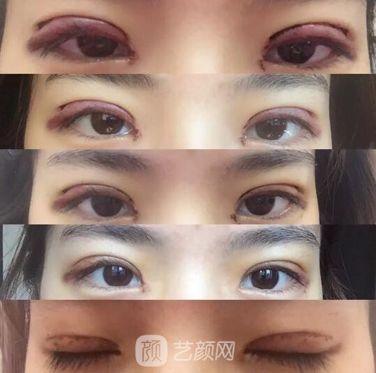 剛做完全切雙眼皮手術(shù)后的樣子