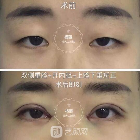 雙側重瞼+內(nèi)外眥開大+雙側上瞼下垂矯正