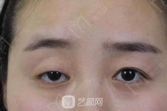 上瞼下垂如果不重視雙眼皮做了也白做！
