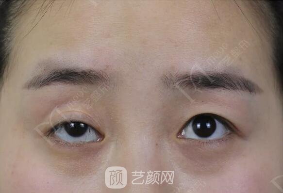 上瞼下垂如果不重視雙眼皮做了也白做！