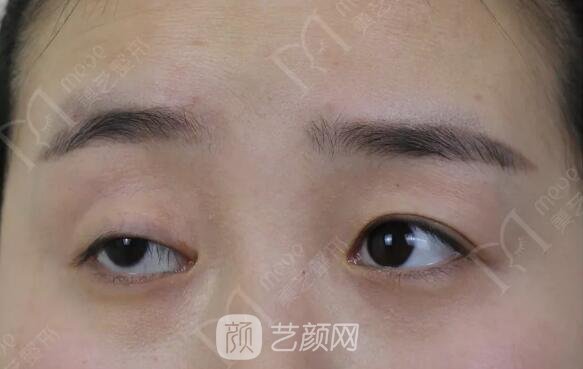 上瞼下垂如果不重視雙眼皮做了也白做！