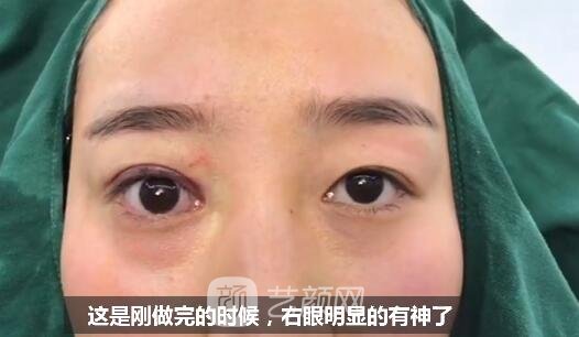 上瞼下垂如果不重視雙眼皮做了也白做！