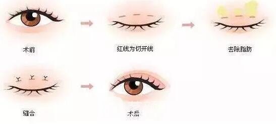 部分切開(kāi)微創(chuàng)法雙眼皮