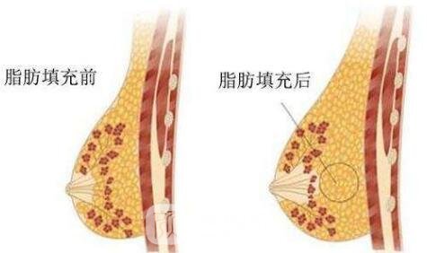 注射豐胸除開觸感好還具有什么優(yōu)點(diǎn)呢?