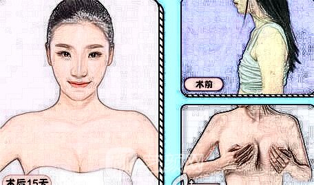 隆胸優(yōu)惠活動(dòng)價(jià)錢大約多少錢?