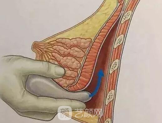 妙桃假體的三大特點