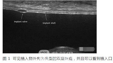 新視角：隆胸術(shù)后的新煩惱！
