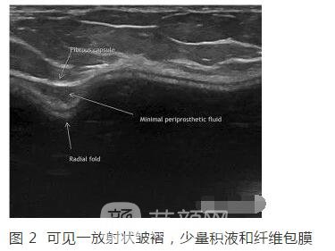 新視角：隆胸術(shù)后的新煩惱！