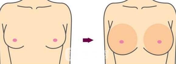 隆胸后，你會(huì)給你的胸部打多少分？