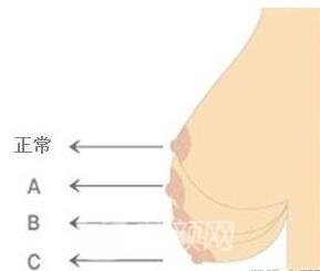 如何分辨胸部下垂程度呢?