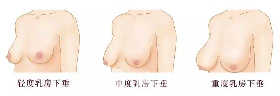胸部下垂可分成哪幾種呢?