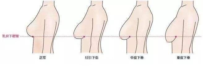 胸部下垂可分成哪幾種呢?