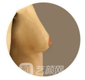 對于乳房下垂有什么糾正方式呢?