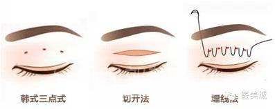 北京做雙眼皮手術(shù)要多少錢