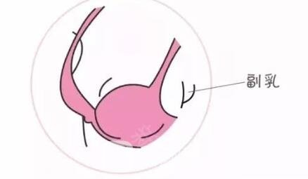 四個姿勢改進隱匿性副乳~