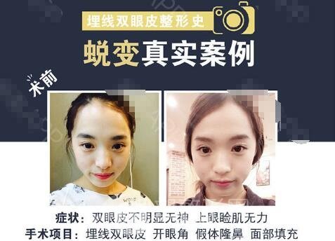 韓國割雙眼皮多少錢