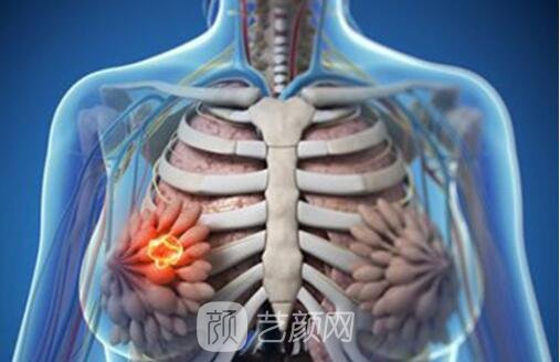 乳腺結節(jié)良性和惡性的區(qū)別