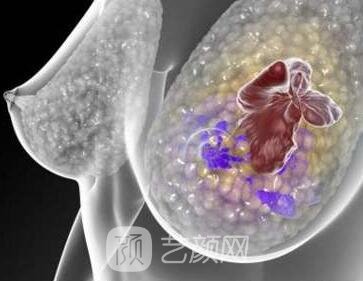 乳腺結節(jié)良性和惡性的區(qū)別