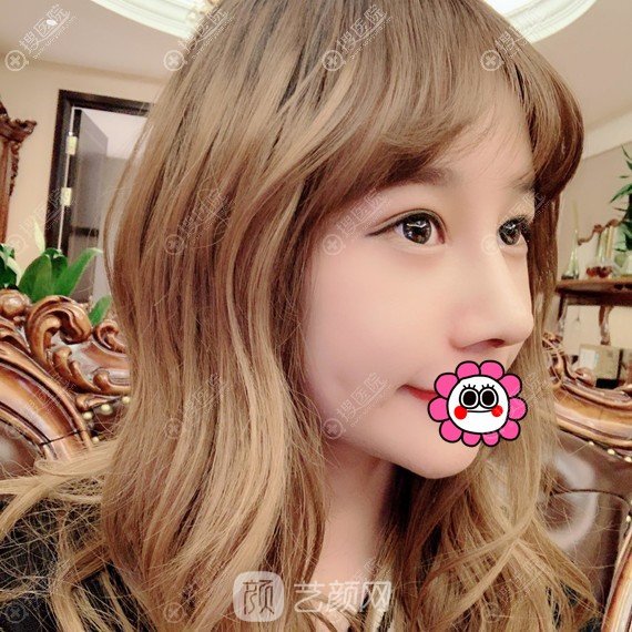 北京畫美于智宏自體肋軟骨隆鼻案例