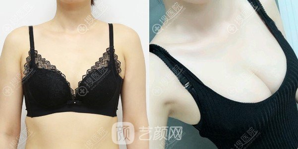 北京圣嘉新李朕自體脂肪豐胸案例