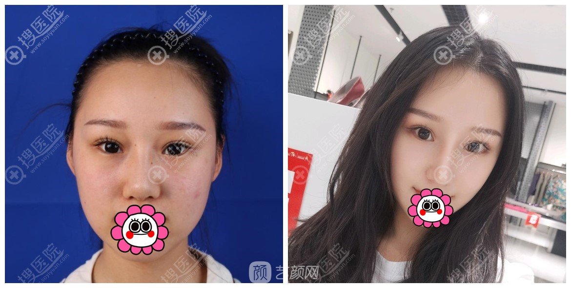 西安畫美楊萬(wàn)忠肋骨鼻果