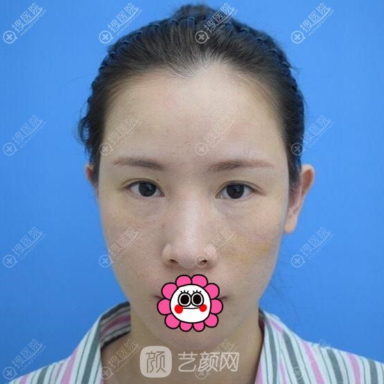 做自體脂肪面部填充前