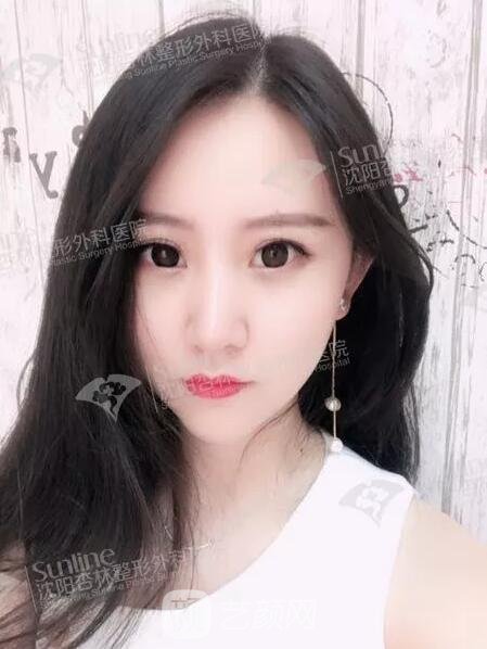 沈陽(yáng)杏林張宇夫鼻部手術(shù)案例