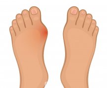 腳骨拐矯正需要多少錢？