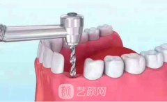 奧齒泰種植牙價格多少錢