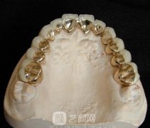 純鈦金屬牙齒好不好？當