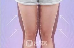 大腿內(nèi)側(cè)吸脂多久恢復(fù)？