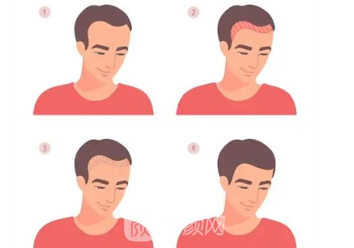 重慶種植頭發(fā)多少一個(gè)毛