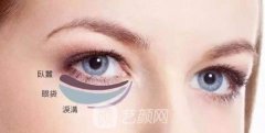 內(nèi)切眼袋恢復(fù)期要多久？