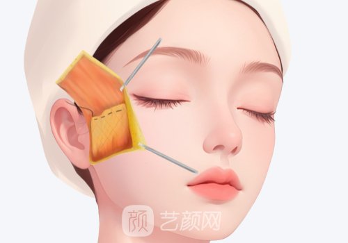 童顏微提3.0多少錢(qián)?價(jià)格及