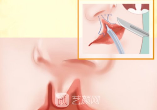 兔唇修補是國家免費嗎?技