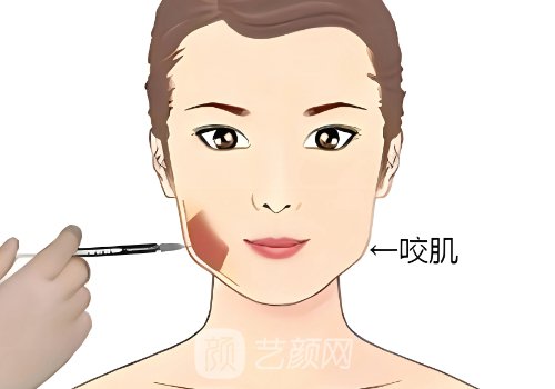 伊維蘭5d童顏針什么價(jià)格