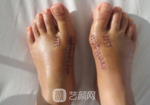 腳骨拐矯正需要多少錢?價(jià)