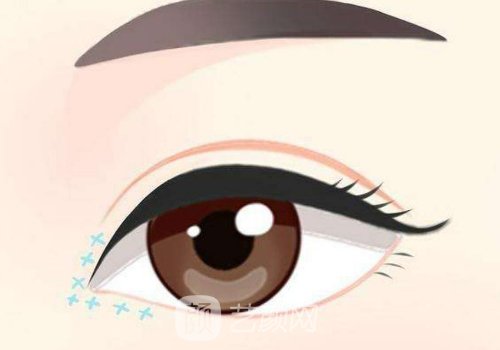 平行雙眼皮修復(fù)成扇形案