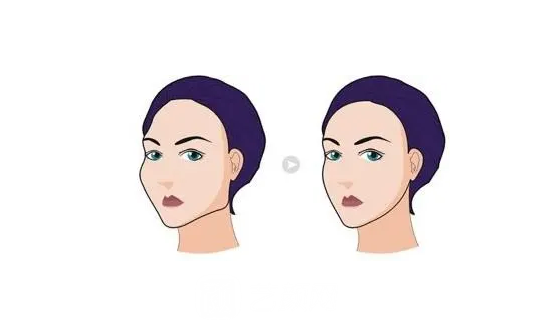 內(nèi)推顴骨手術(shù)多少錢?3萬(wàn)夠