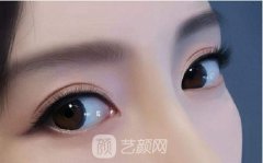 全切雙眼皮二次修復(fù)時(shí)間