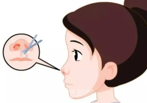 膨體假體隆鼻價格貴嗎?收